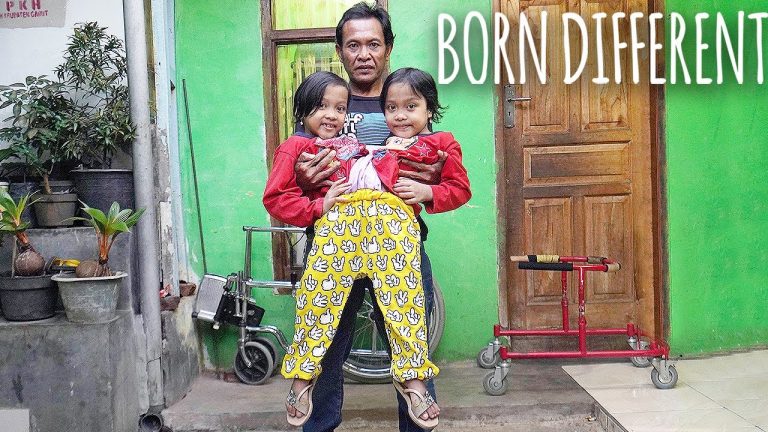 We’re Conjoined Twins Who Share Legs | BORN DIFFERENT